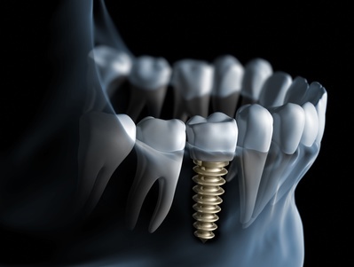 Kiedy polecane są implanty zębowe?